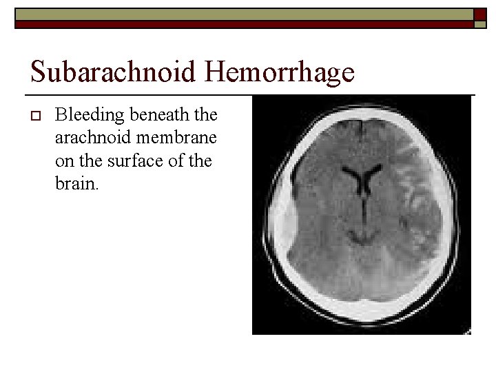 Subarachnoid Hemorrhage o Bleeding beneath the arachnoid membrane on the surface of the brain.