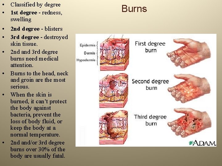 • Classified by degree • 1 st degree - redness, swelling • 2 • Classified by degree • 1 st degree - redness, swelling • 2