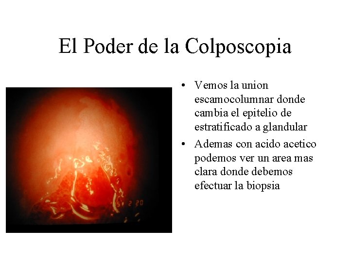 El Poder de la Colposcopia • Vemos la union escamocolumnar donde cambia el epitelio El Poder de la Colposcopia • Vemos la union escamocolumnar donde cambia el epitelio