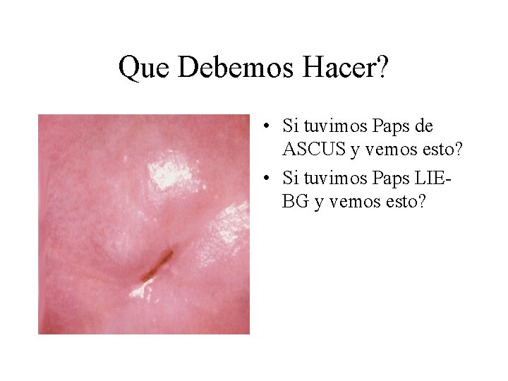 Que Debemos Hacer? • Si tuvimos Paps de ASCUS y vemos esto? • Si Que Debemos Hacer? • Si tuvimos Paps de ASCUS y vemos esto? • Si