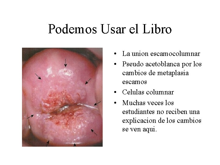 Podemos Usar el Libro • La union escamocolumnar • Pseudo acetoblanca por los cambios Podemos Usar el Libro • La union escamocolumnar • Pseudo acetoblanca por los cambios