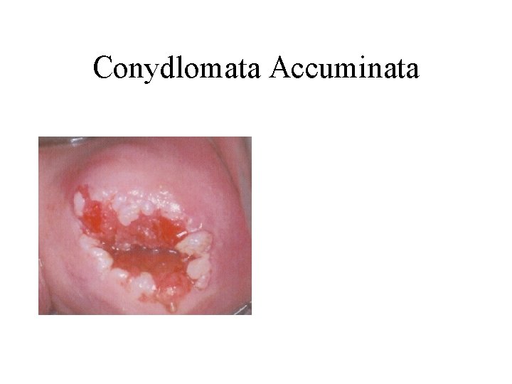 Conydlomata Accuminata Conydlomata Accuminata