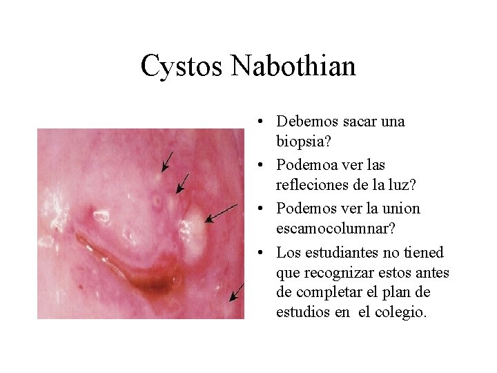 Cystos Nabothian • Debemos sacar una biopsia? • Podemoa ver las refleciones de la Cystos Nabothian • Debemos sacar una biopsia? • Podemoa ver las refleciones de la