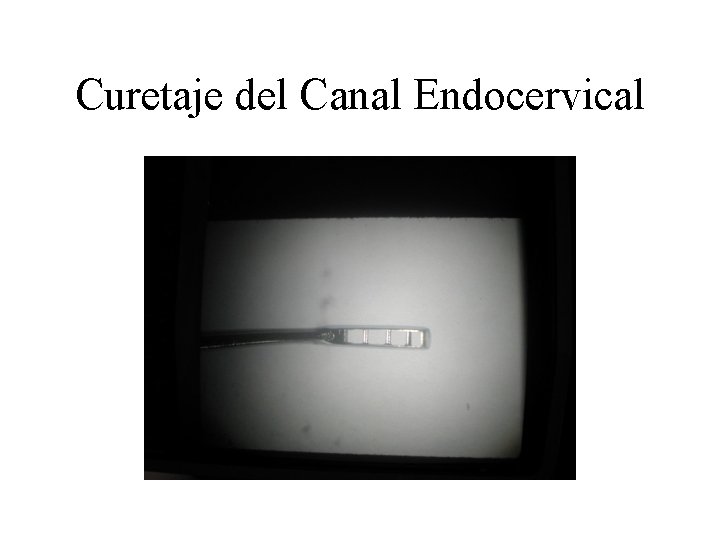Curetaje del Canal Endocervical Curetaje del Canal Endocervical