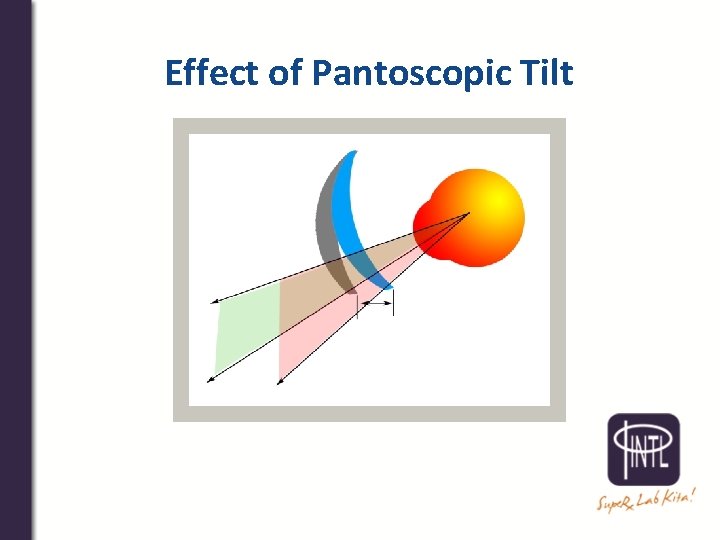 Effect of Pantoscopic Tilt 
