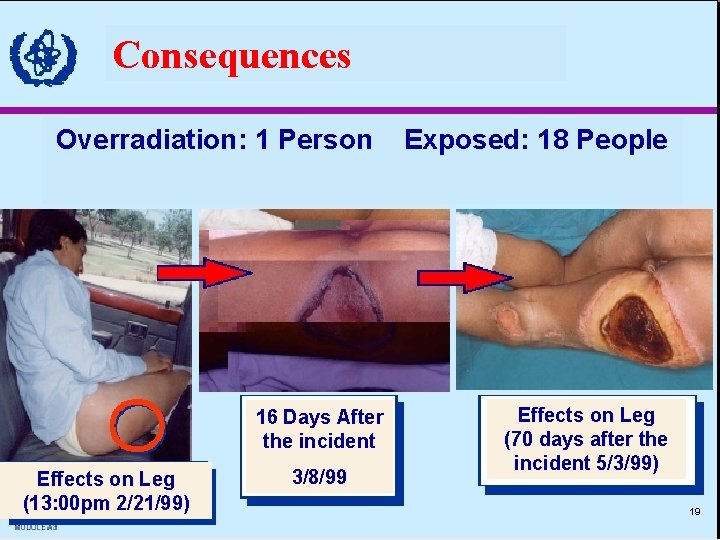 Consequences Overradiation: 1 Person 16 Days After the incident Effects on Leg (13: 00