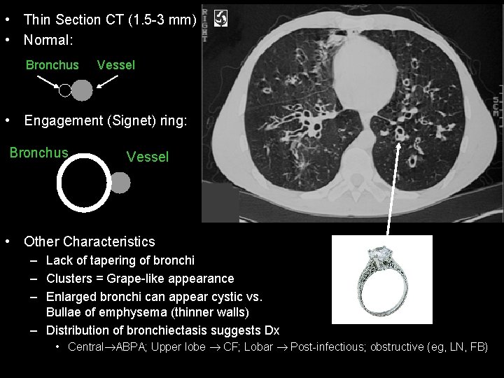  • Thin Section CT (1. 5 -3 mm) • Normal: Bronchus Vessel •