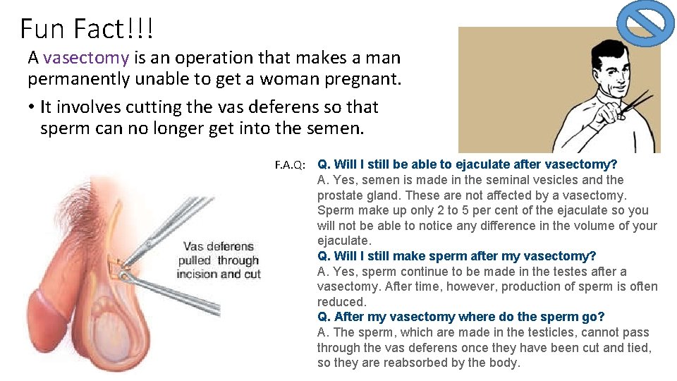 Fun Fact!!! A vasectomy is an operation that makes a man permanently unable to