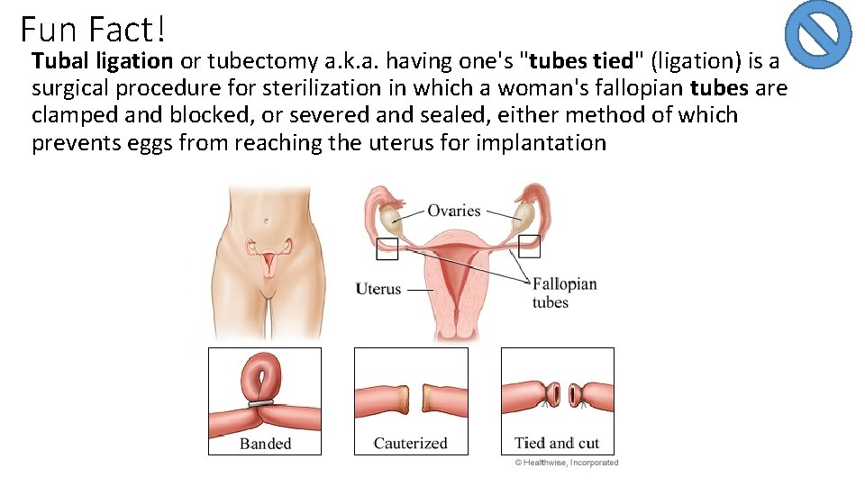 Fun Fact! Tubal ligation or tubectomy a. k. a. having one's "tubes tied" (ligation)