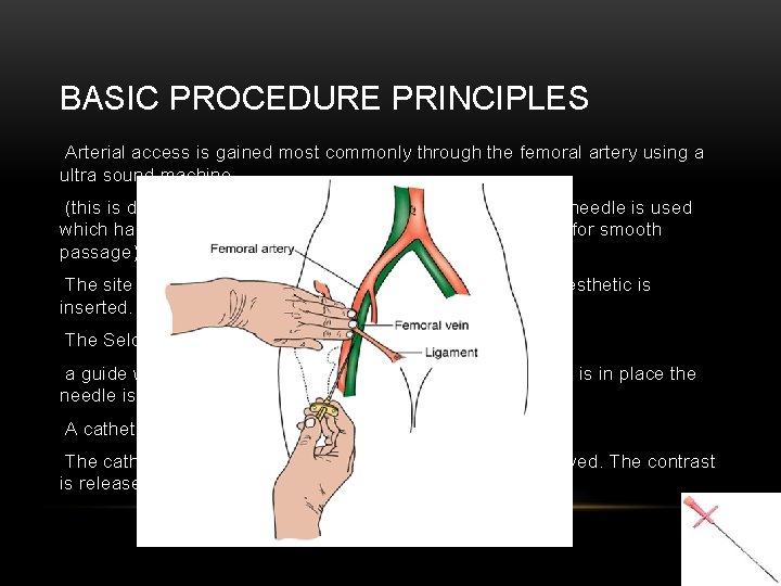 BASIC PROCEDURE PRINCIPLES Arterial access is gained most commonly through the femoral artery using