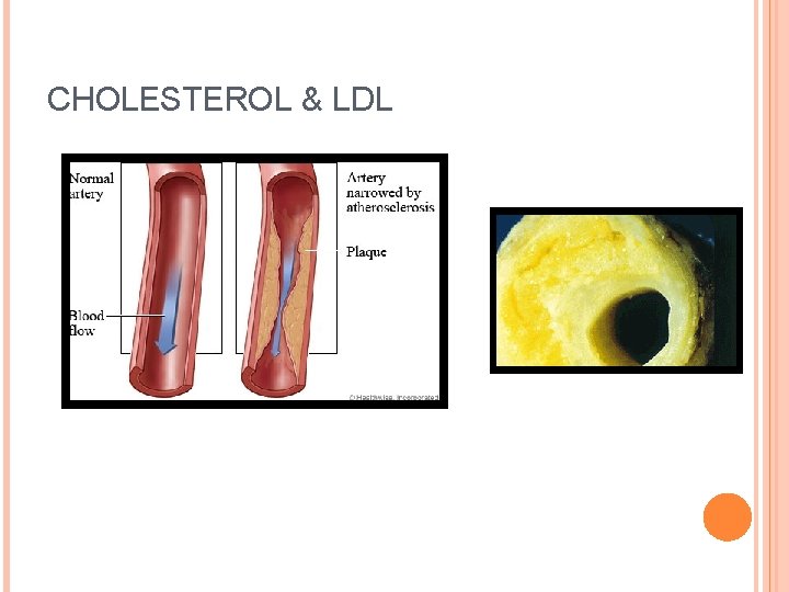 CHOLESTEROL & LDL 