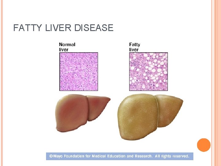 FATTY LIVER DISEASE 