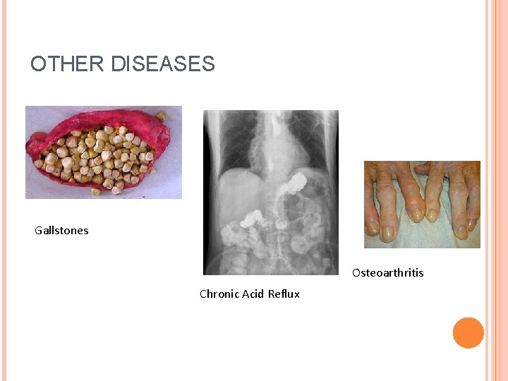 OTHER DISEASES Gallstones Osteoarthritis Chronic Acid Reflux 