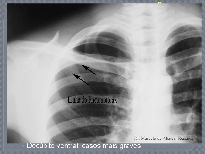 INSUFICIÊNCIA RESPIRATÓRIA �SDRA (V): Tratamento: • VM por TOT com volume corrente < 6