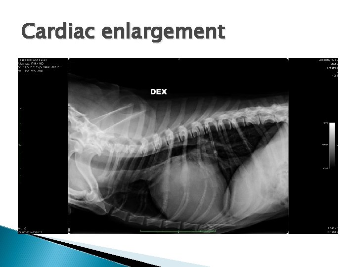 Cardiac enlargement 