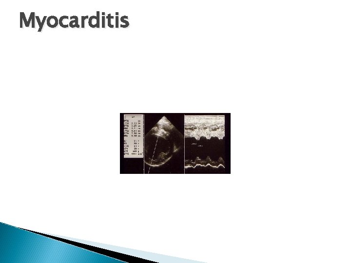 Myocarditis 