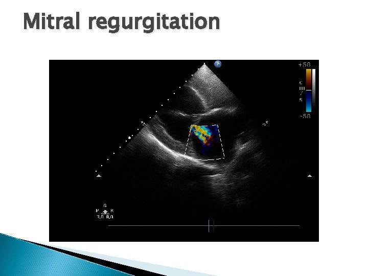 Mitral regurgitation 