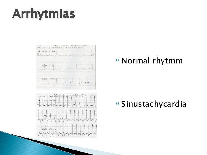Arrhytmias Normal rhytmm Sinustachycardia 