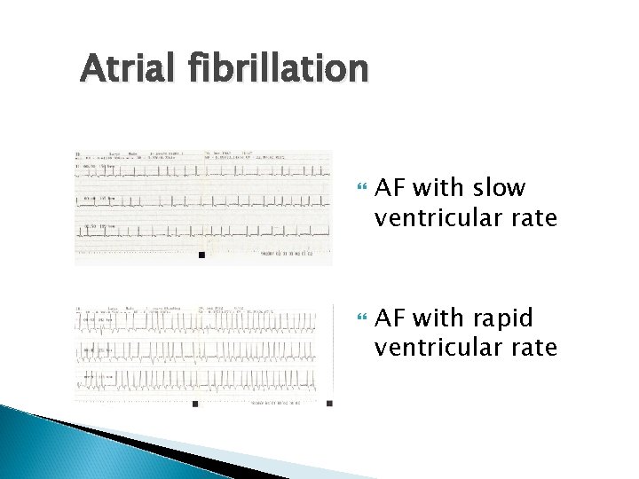 Atrial fibrillation AF with slow ventricular rate AF with rapid ventricular rate 