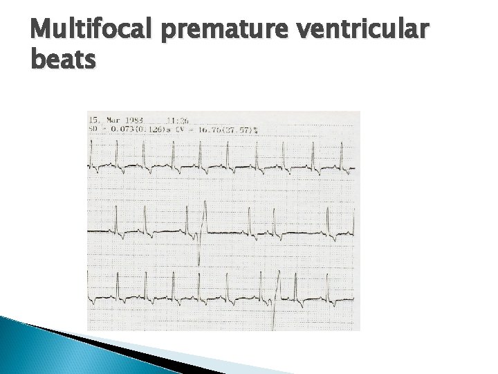 Multifocal premature ventricular beats 