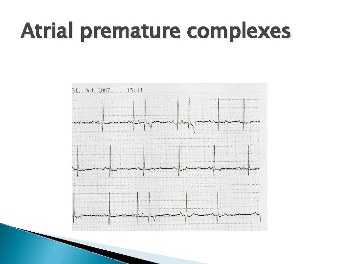 Atrial premature complexes 