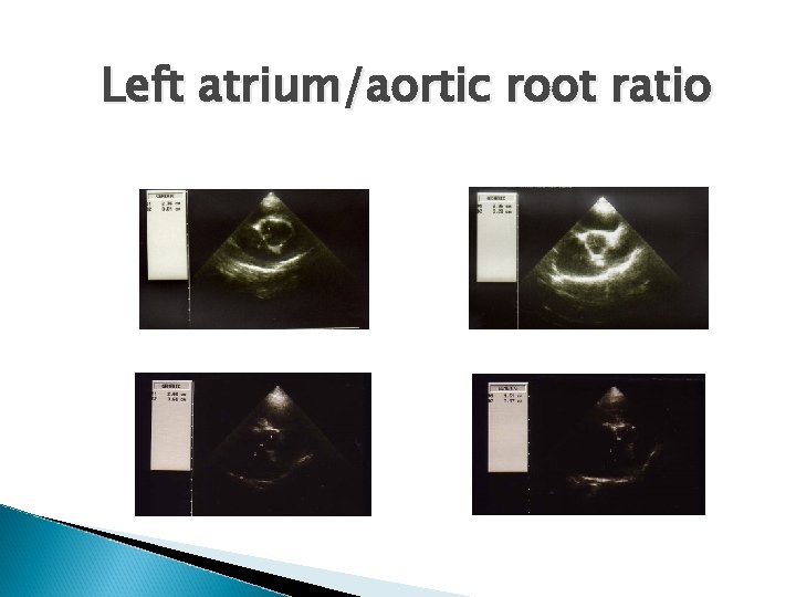Left atrium/aortic root ratio 