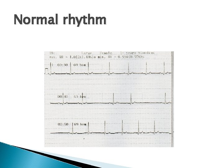 Normal rhythm 
