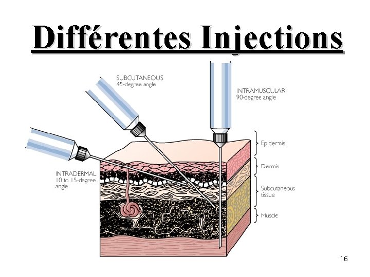 Différentes Injections 16 