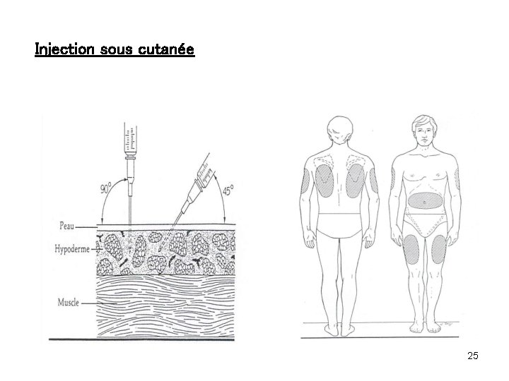 Injection sous cutanée 25 