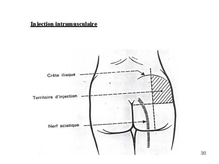 Injection intramusculaire 30 