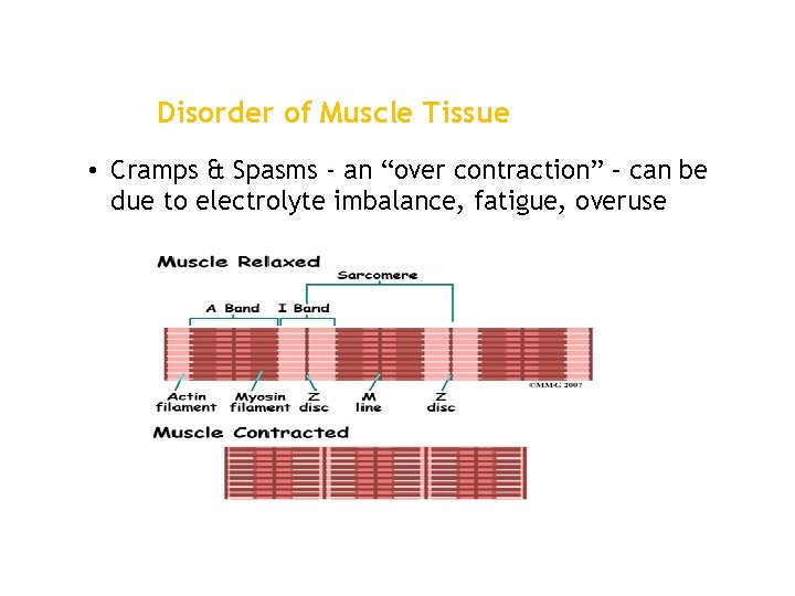 Disorder of Muscle Tissue • Cramps & Spasms - an “over contraction” – can