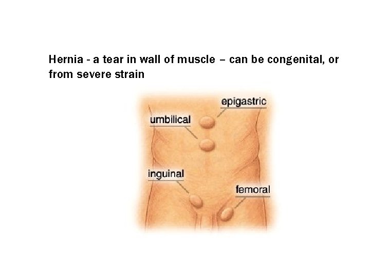 Hernia - a tear in wall of muscle – can be congenital, or from