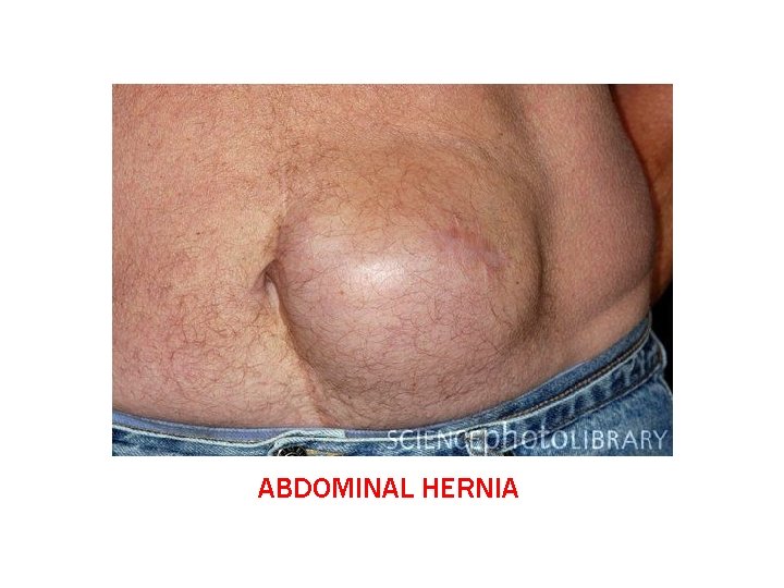 ABDOMINAL HERNIA 