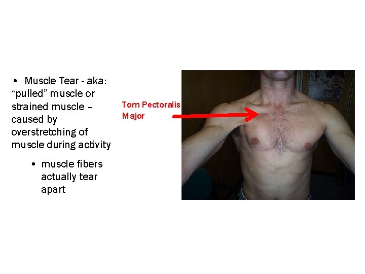  • Muscle Tear - aka: “pulled” muscle or strained muscle – caused by