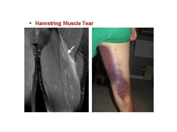  • Hamstring Muscle Tear 