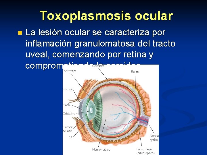 Toxoplasmosis ocular n La lesión ocular se caracteriza por inflamación granulomatosa del tracto uveal,