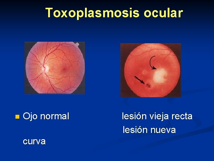 Toxoplasmosis ocular n Ojo normal curva lesión vieja recta lesión nueva 