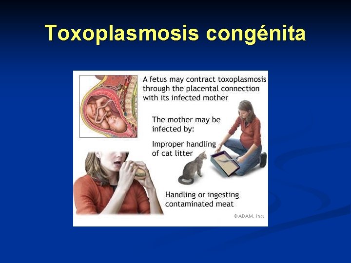 Toxoplasmosis congénita Toxoplasmosis congénita