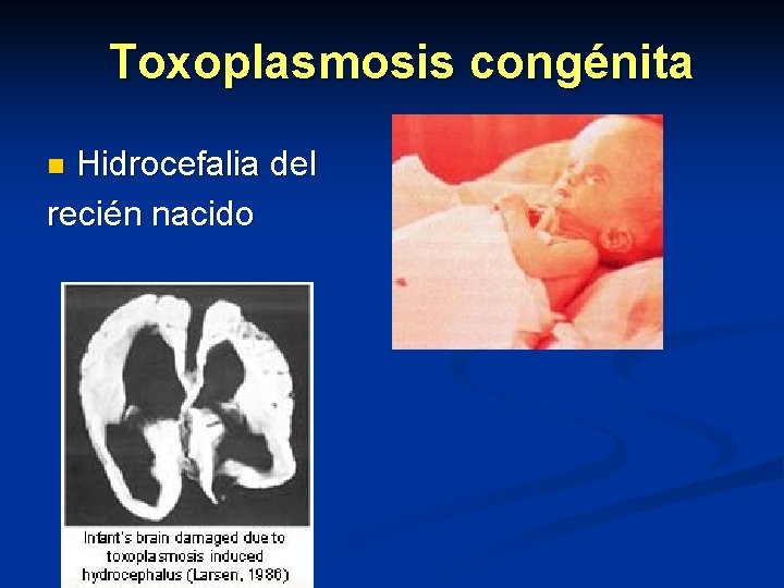 Toxoplasmosis congénita Hidrocefalia del recién nacido n 