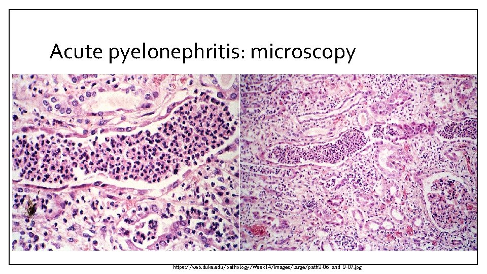 Acute pyelonephritis: microscopy https: //web. duke. edu/pathology/Week 14/images/large/path 9 -06 and 9 -07. jpg