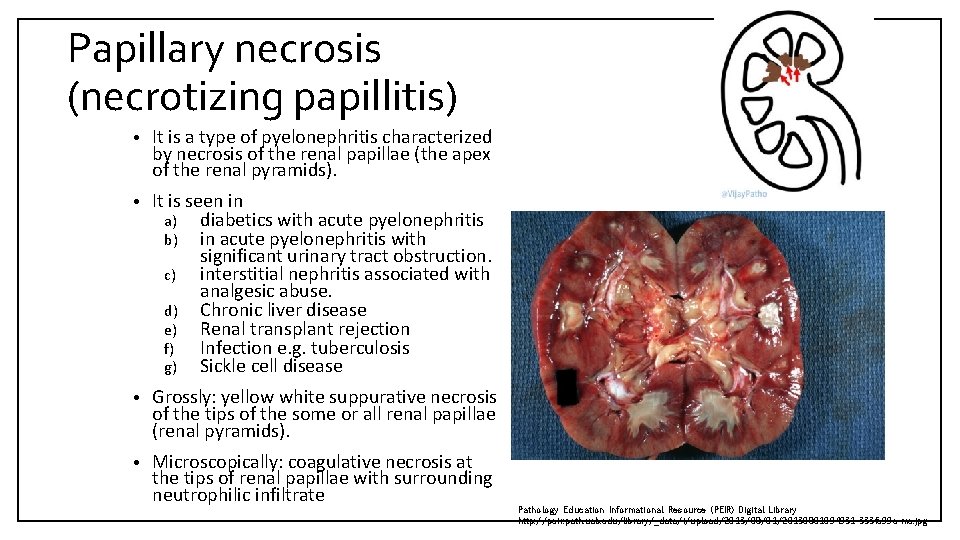 Papillary necrosis (necrotizing papillitis) • It is a type of pyelonephritis characterized by necrosis