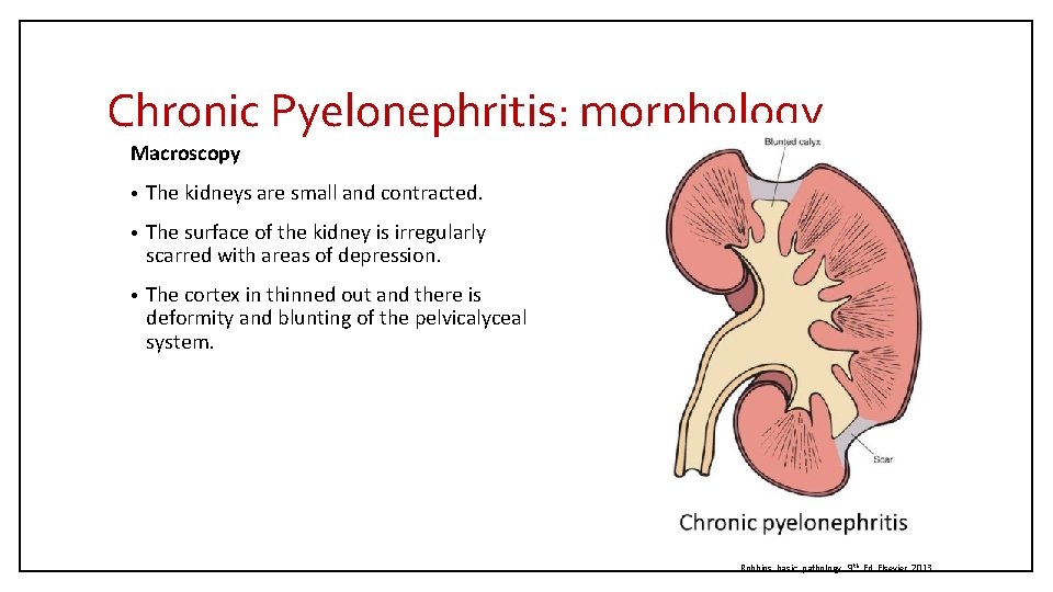 Chronic Pyelonephritis: morphology Macroscopy • The kidneys are small and contracted. • The surface