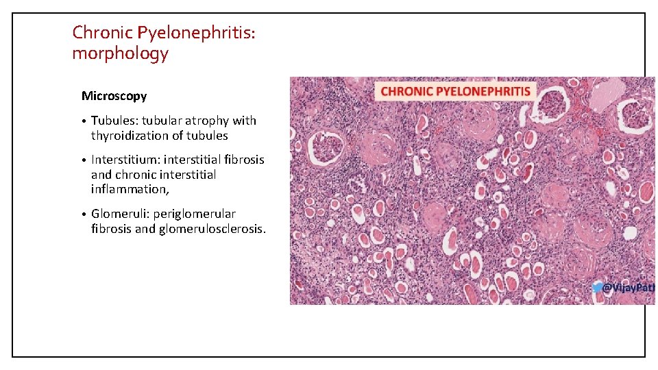 Chronic Pyelonephritis: morphology Microscopy • Tubules: tubular atrophy with thyroidization of tubules • Interstitium: