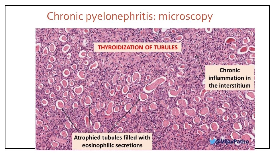 Chronic pyelonephritis: microscopy 