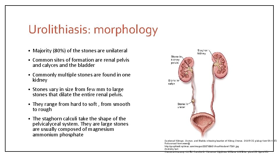 Urolithiasis: morphology • Majority (80%) of the stones are unilateral • Common sites of