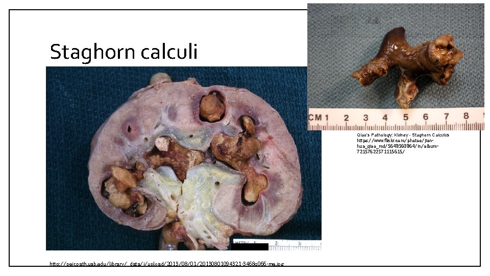 Staghorn calculi Qiao's Pathology: Kidney - Staghorn Calculus https: //www. flickr. com/photos/jianhua_qiao_md/5648360864/in/album 72157622371115615/ http: