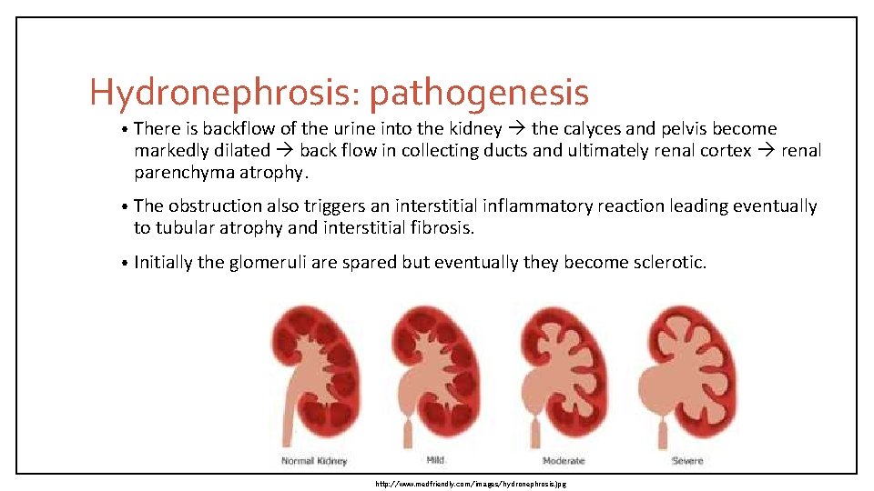 Hydronephrosis: pathogenesis • There is backflow of the urine into the kidney the calyces