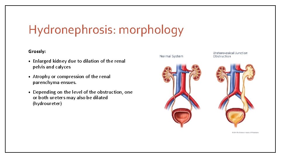 Hydronephrosis: morphology Grossly: • Enlarged kidney due to dilation of the renal pelvis and