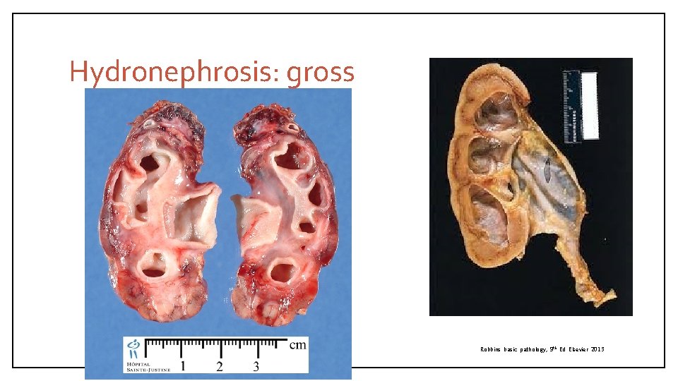 Hydronephrosis: gross Robbins basic pathology, 9 th Ed Elsevier 2013 