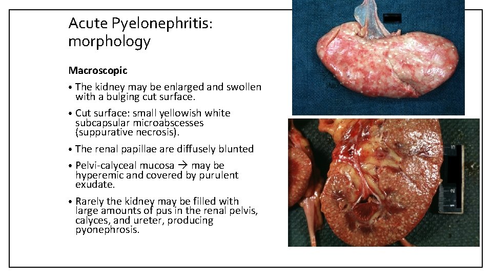 Acute Pyelonephritis: morphology Macroscopic • The kidney may be enlarged and swollen with a